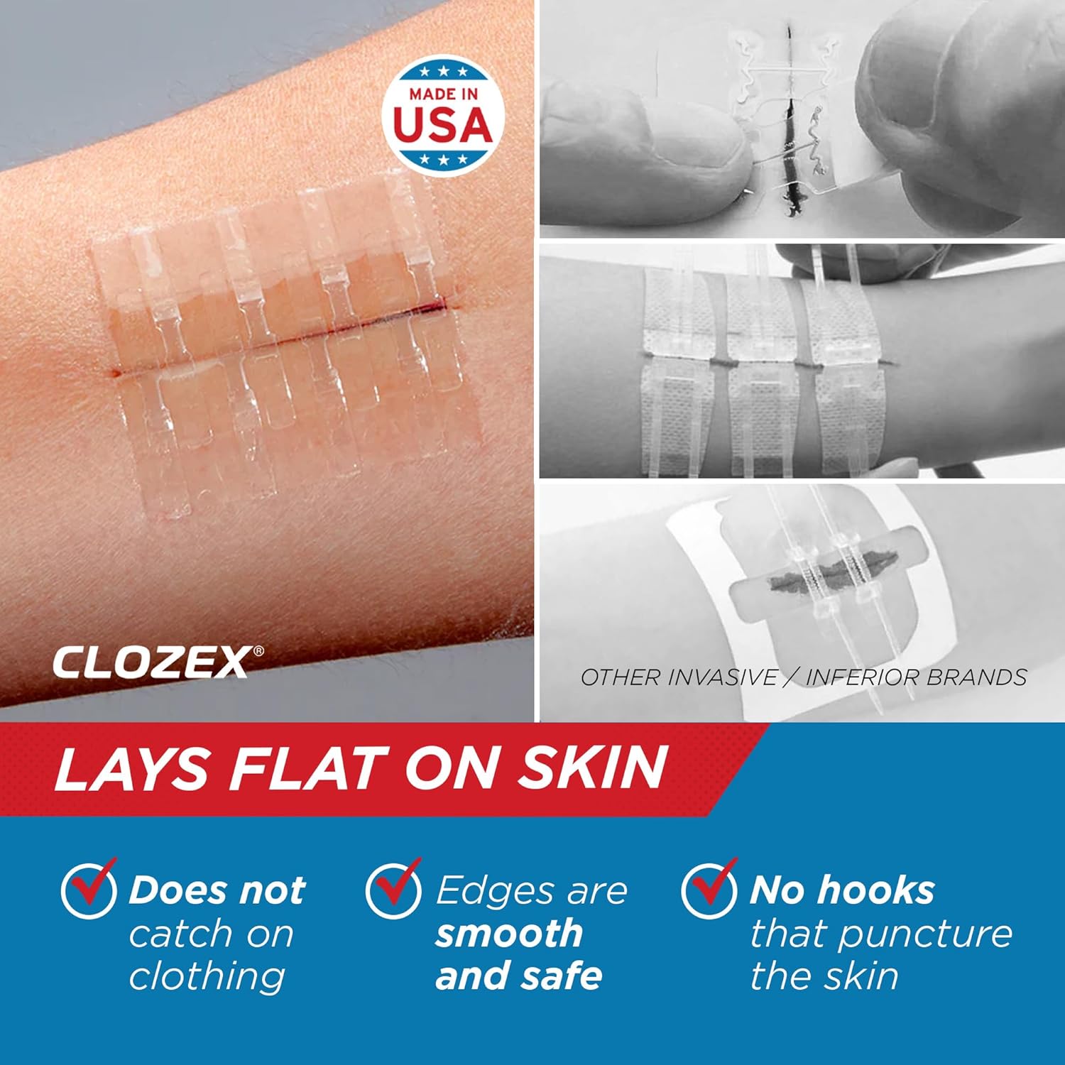 Clozex Emergency Laceration Closures