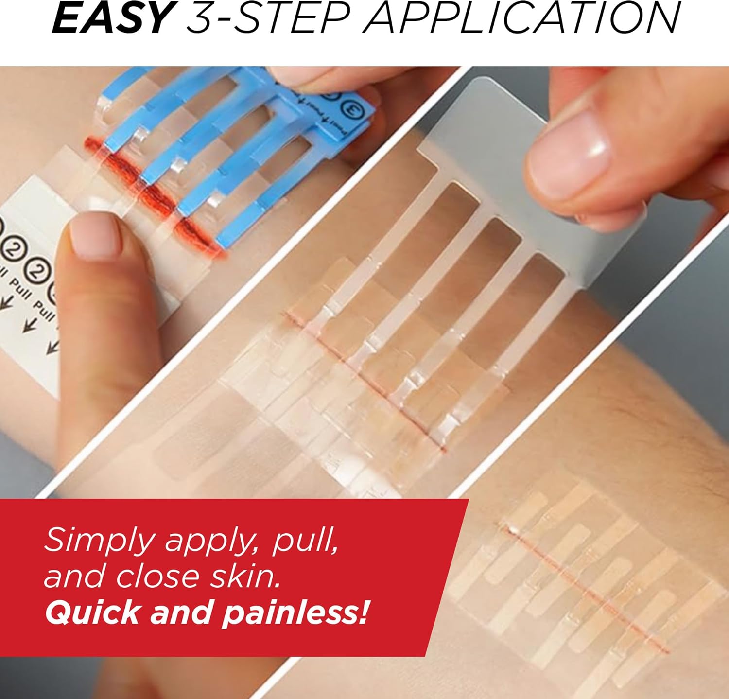 Clozex Emergency Laceration Closures